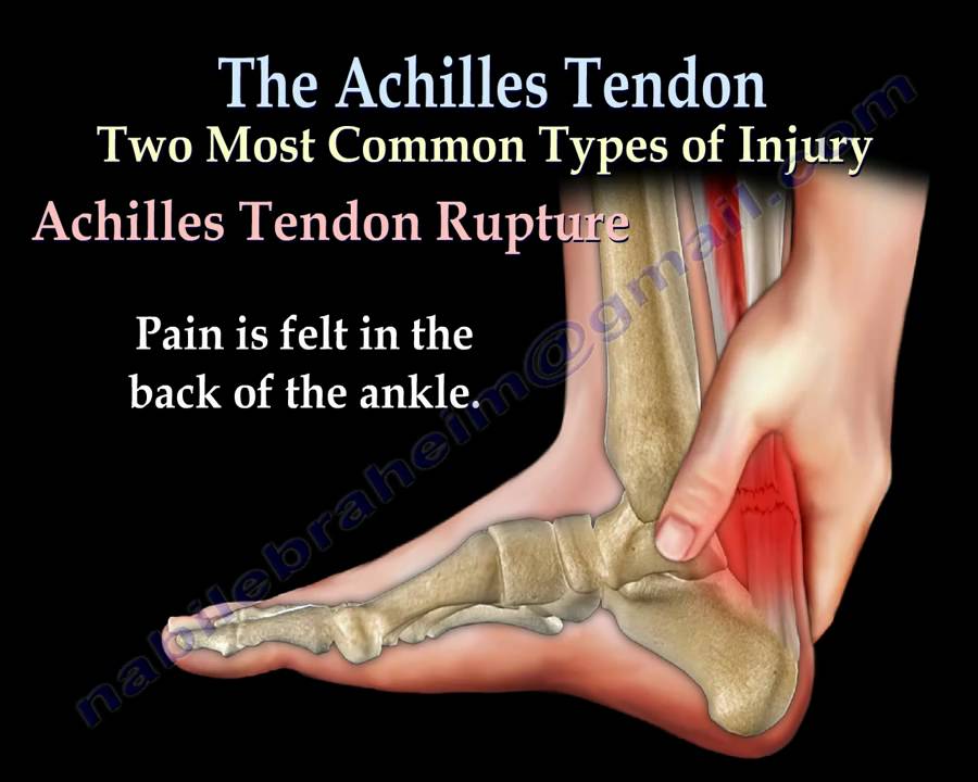 Understanding Achilles Tendon Injury Anatomy of the Achilles Tendon